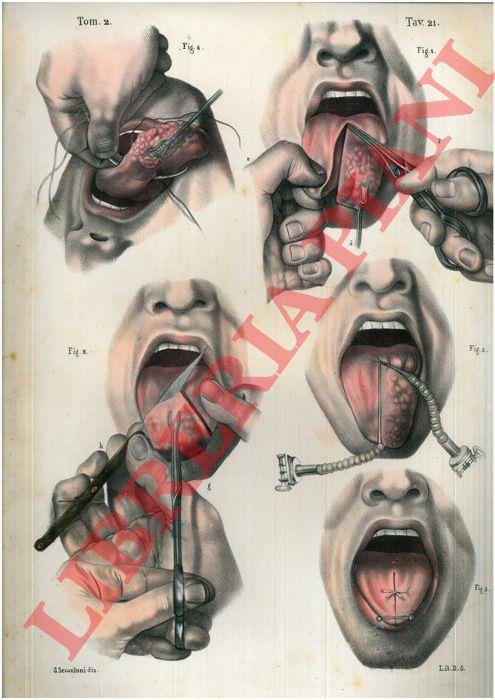 Cancro della lingua - copertina