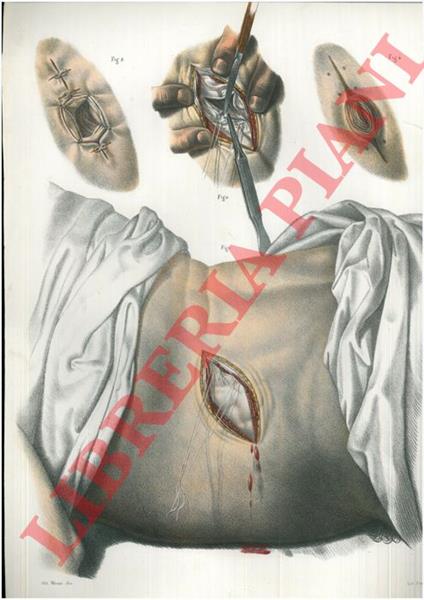 Ani artificiali. Ano artificiale lombare sinistro - copertina
