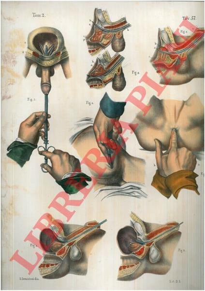 Operazioni diverse sull'uretra, la prostata e la vessica - copertina
