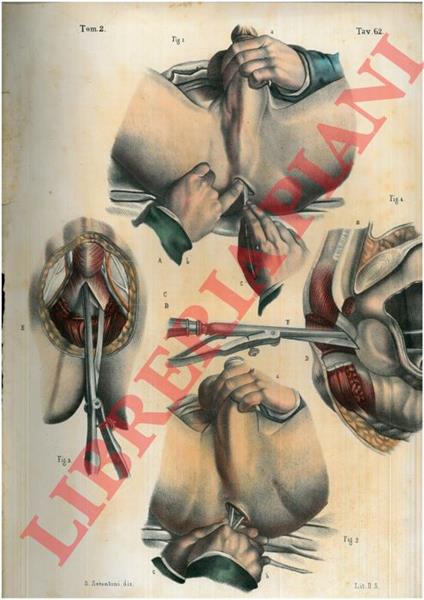 Operazioni della litotomia - copertina