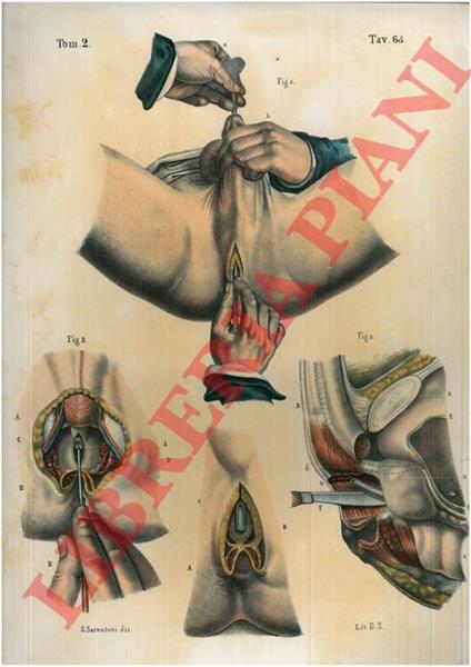 Operazioni della litotomia - copertina