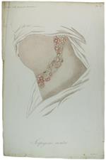 Tavola originale: SERPIGINE ACUTA. N. 6 (da: CLINICA DEL PARIGINO SPEDALE DI S.LUIGI OSSIA TRATTATO COMPIUTO DELLA PELLE ...)
