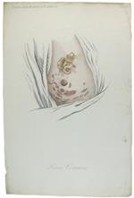 Tavola originale: LEUCE COMUNE., N. 38 (da: CLINICA DEL PARIGINO SPEDALE DI S.LUIGI OSSIA TRATTATO COMPIUTO DELLA PELLE ...)