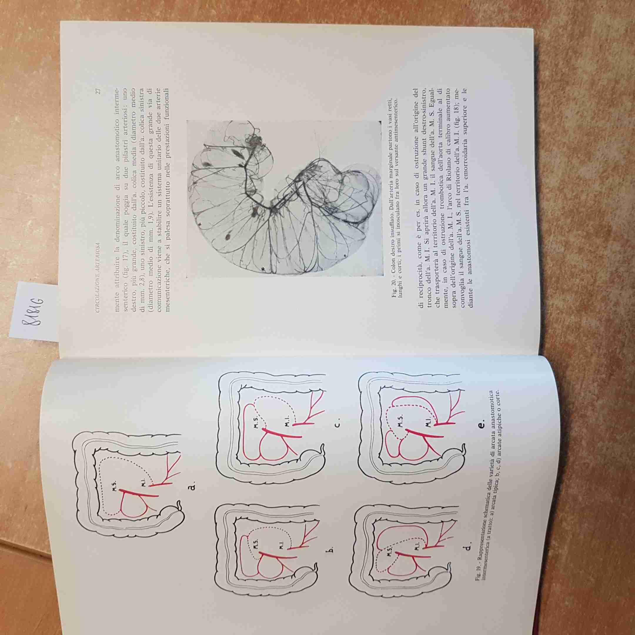Chirurgia Del Cancro Del Colon E Del Retto 1963 Imperati Colosimo - Idelson