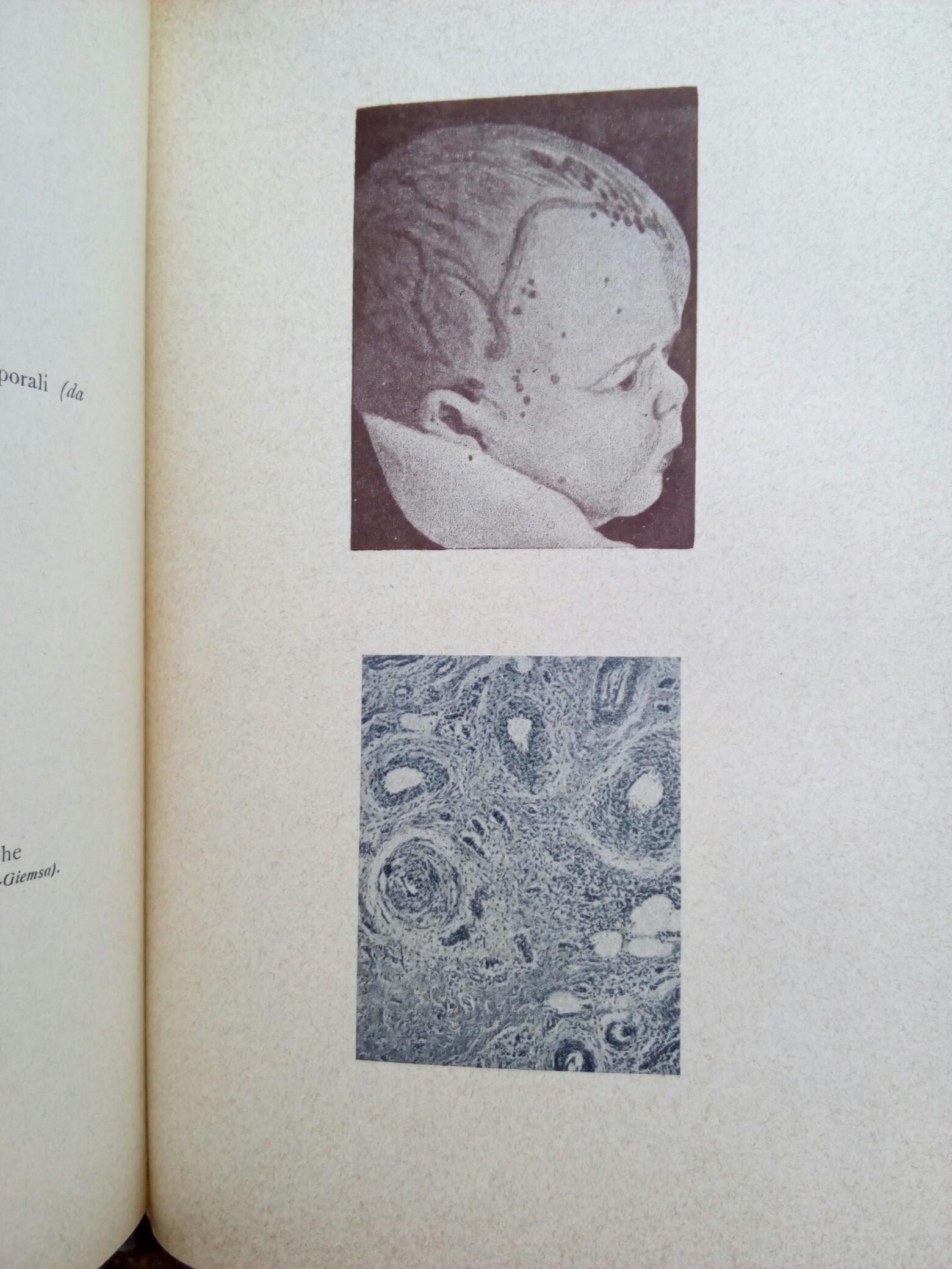 La sifilide ignorata e strana Napoli 1923