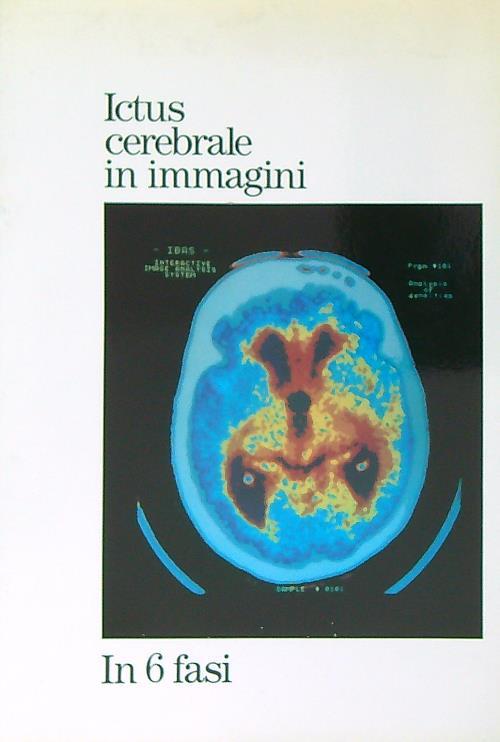 Ictus cerebrale in immagini. In 6 fasi