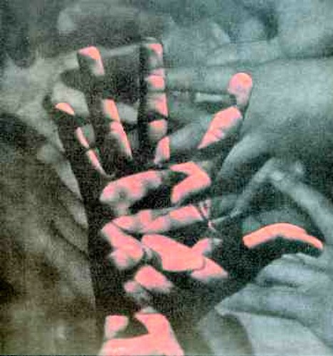 ibs
