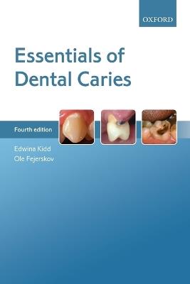Essentials of Dental Caries - Edwina Kidd,Ole Fejerskov - cover