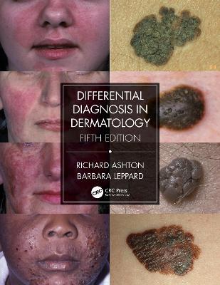 Differential Diagnosis in Dermatology - Richard Ashton,Barbara Leppard - cover