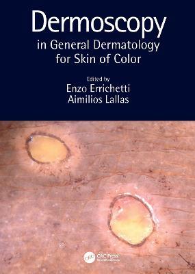 Dermoscopy in General Dermatology for Skin of Color - cover