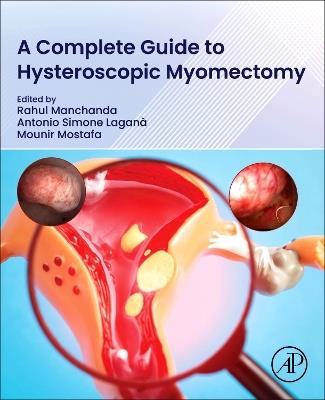 A Complete Guide to Hysteroscopic Myomectomy - cover