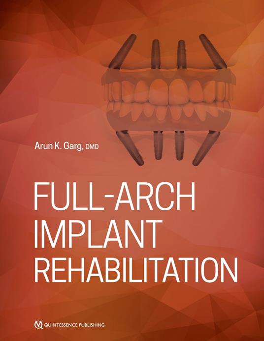 Full-Arch Implant Rehabilitation