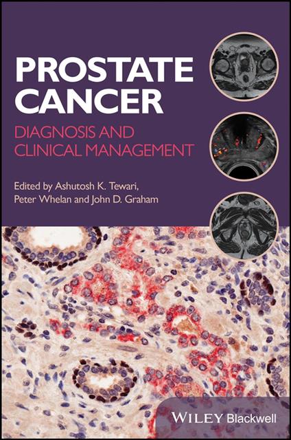 Prostate Cancer
