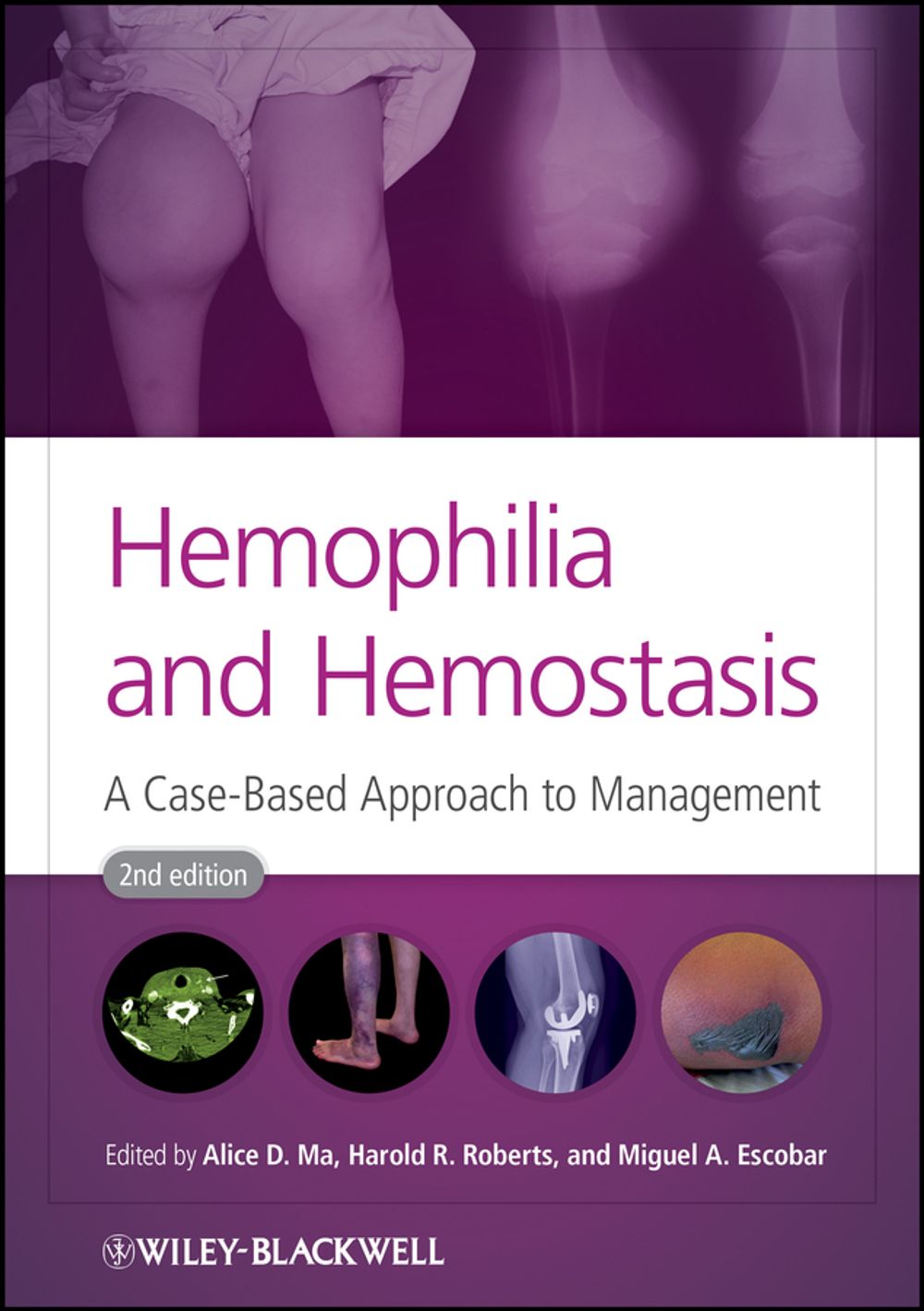 ibs