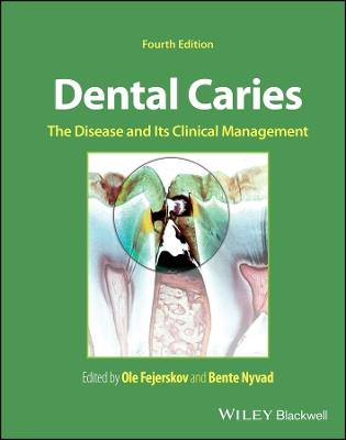 Dental Caries: The Disease and its Clinical Management - cover