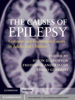 The Causes of Epilepsy