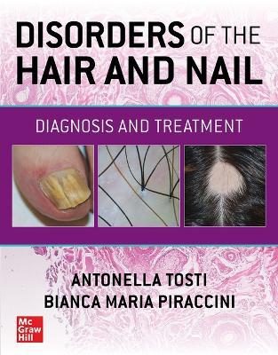 Disorders of the Hair and Nail: Diagnosis and Treatment - Antonella Tosti,Bianca Maria Piraccini - cover