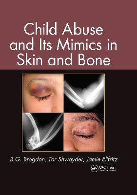 Child Abuse and its Mimics in Skin and Bone - B. G. Brogdon,Tor Shwayder,Jamie Elifritz - cover
