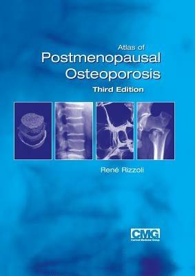 Atlas of Postmenopausal Osteoporosis: Third Edition - cover