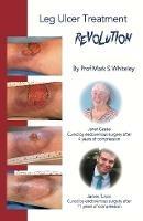 Leg Ulcer Treatment Revolution - Mark Whiteley - cover