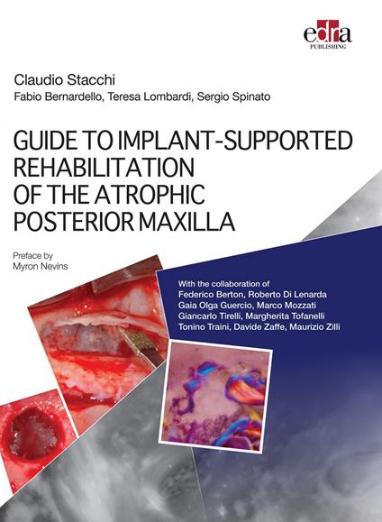 GUIDE TO IMPLANT-SUPPORTED REHABILITATION OF THE ATROPHIC POSTERIOR MAXILLA