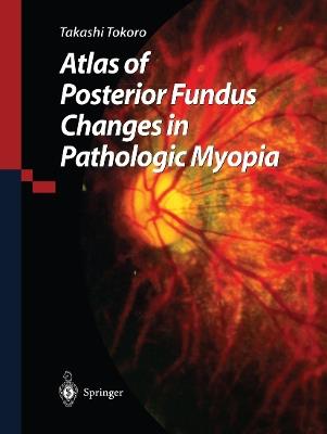 Atlas of Posterior Fundus Changes in Pathologic Myopia - Takashi Tokoro - cover