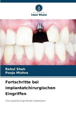 Fortschritte bei implantatchirurgischen Eingriffen - Rahul Shah,Pooja Mishra - cover