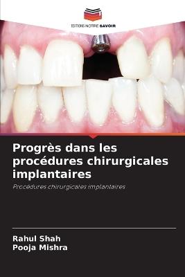 Progr?s dans les proc?dures chirurgicales implantaires - Rahul Shah,Pooja Mishra - cover