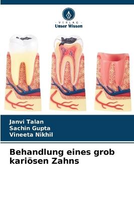 Behandlung eines grob kari?sen Zahns - Janvi Talan,Sachin Gupta,Vineeta Nikhil - cover