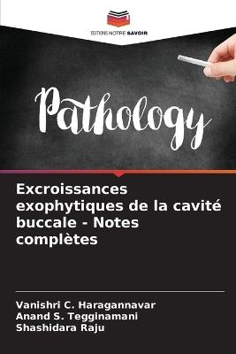 Excroissances exophytiques de la cavit? buccale - Notes compl?tes - Vanishri C Haragannavar,Anand S Tegginamani,Shashidara Raju - cover