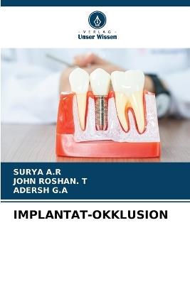 Implantat-Okklusion - Surya A R,John Roshan T,Adersh G a - cover