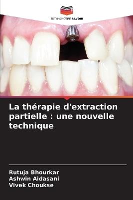 La th?rapie d'extraction partielle: une nouvelle technique - Rutuja Bhourkar,Ashwin Aidasani,Vivek Choukse - cover