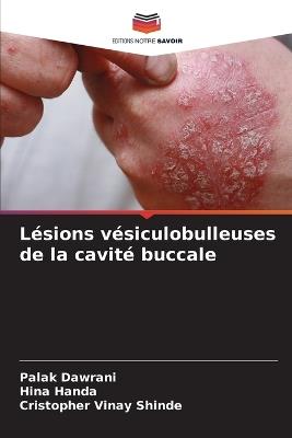Lésions vésiculobulleuses de la cavité buccale - Palak Dawrani,Hina Handa,Cristopher Vinay Shinde - cover