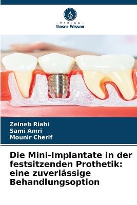 Die Mini-Implantate in der festsitzenden Prothetik: eine zuverlässige Behandlungsoption - Zeineb Riahi,Sami Amri,Mounir Cherif - cover