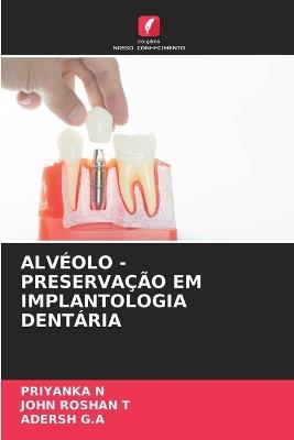 Alvéolo - Preservação Em Implantologia Dentária - Priyanka N,John Roshan T,Adersh G a - cover