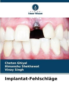 Implantat-Fehlschläge - Chetan Ghiyal,Himanshu Shekhawat,Vinay Singh - cover