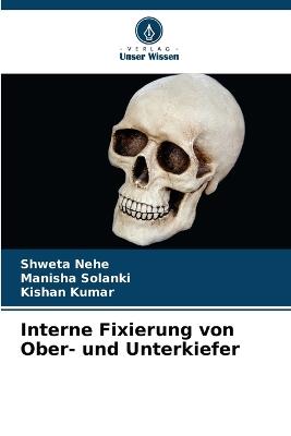 Interne Fixierung von Ober- und Unterkiefer - Shweta Nehe,Manisha Solanki,Kishan Kumar - cover