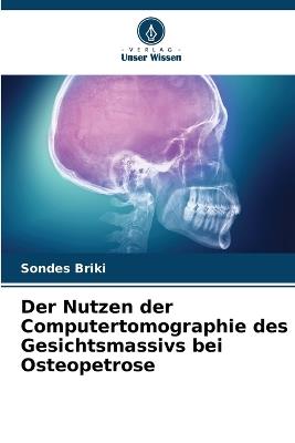 Der Nutzen der Computertomographie des Gesichtsmassivs bei Osteopetrose - Sondes Briki - cover