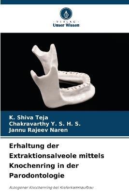 Erhaltung der Extraktionsalveole mittels Knochenring in der Parodontologie - K Shiva Teja,Chakravarthy Y S H S,Jannu Rajeev Naren - cover