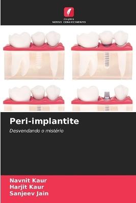 Peri-implantite - Navnit Kaur,Harjit Kaur,Sanjeev Jain - cover