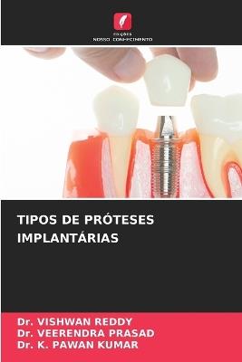 Tipos de Próteses Implantárias - Vishwan Reddy,Veerendra Prasad,K Pawan Kumar - cover