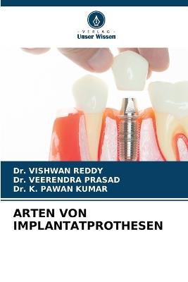 Arten Von Implantatprothesen - Vishwan Reddy,Veerendra Prasad,K Pawan Kumar - cover