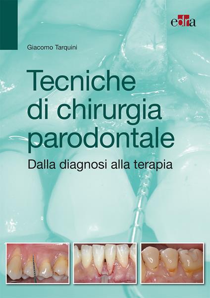 Tecniche di chirurgia parodontale. Dalla diagnosi alla terapia - Giacomo Tarquini - copertina