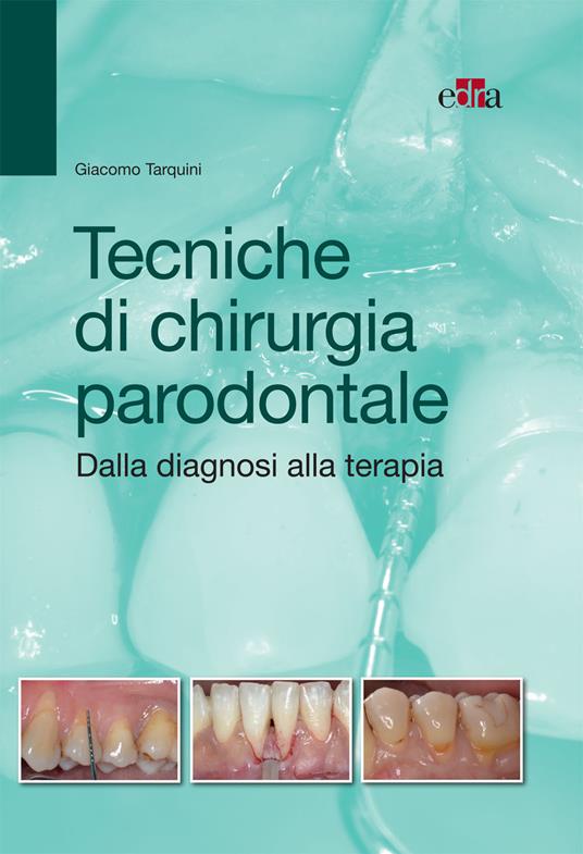 Tecniche di chirurgia parodontale. Dalla diagnosi alla terapia - Giacomo Tarquini - ebook