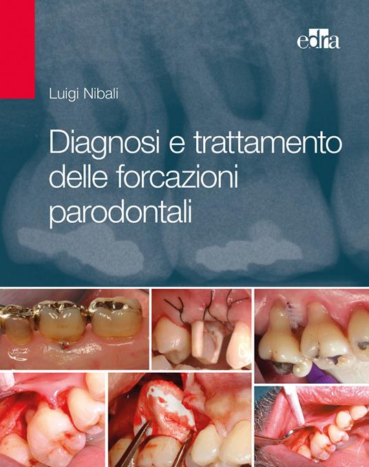 Diagnosi e trattamento delle forcazioni parodontali - Luigi Nibali - copertina