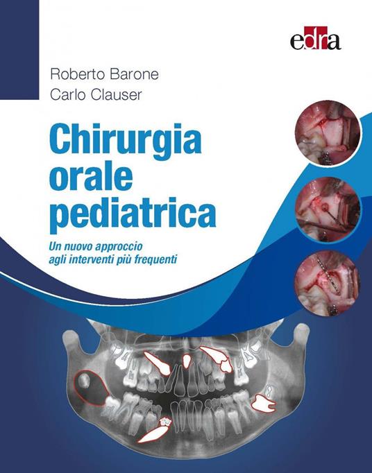 Chirurgia orale pediatrica. Un nuovo approccio agli interventi più frequenti - Roberto Barone,Carlo Clauser - copertina
