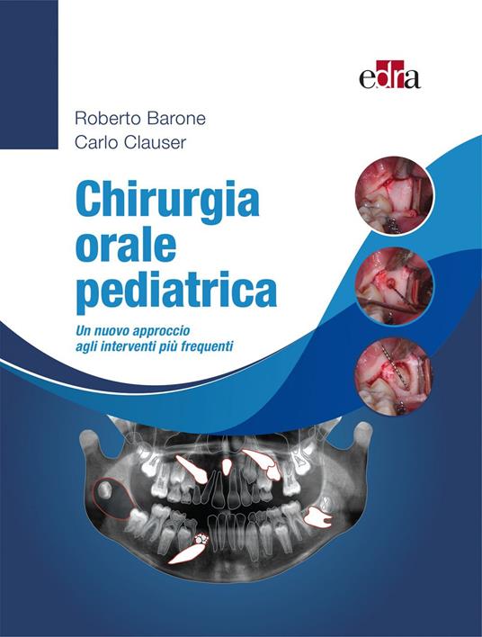 Chirurgia orale pediatrica. Un nuovo approccio agli interventi più frequenti - Roberto Barone,Carlo Clauser - ebook