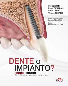 Dente o impianto? Il recupero o la sostituzione del dente naturale gravemente compromesso