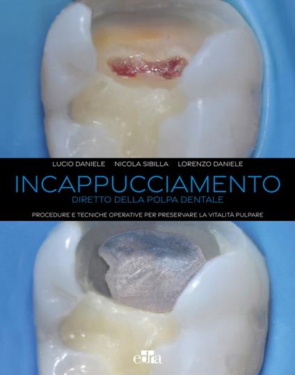 Incappucciamento diretto della polpa dentale. Procedure e tecniche operative per preservare la vitalità pulpare. Con QR code - Lucio Daniele,Nicola Sibilla,Lorenzo Daniele - copertina