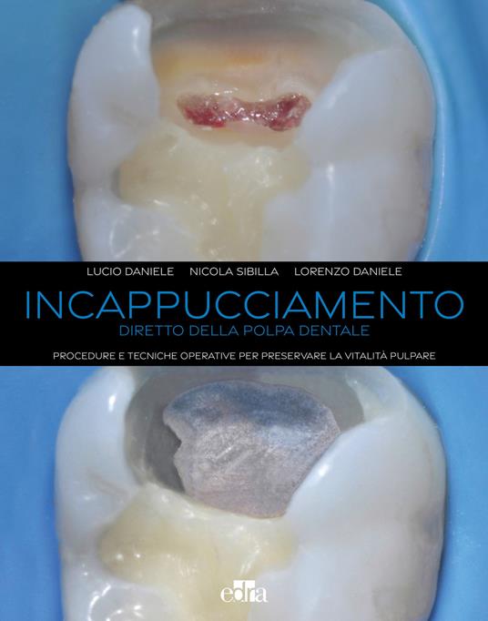 Incappucciamento diretto della polpa dentale. Procedure e tecniche operative per preservare la vitalità pulpare. Con QR code - Lucio Daniele,Nicola Sibilla,Lorenzo Daniele - copertina